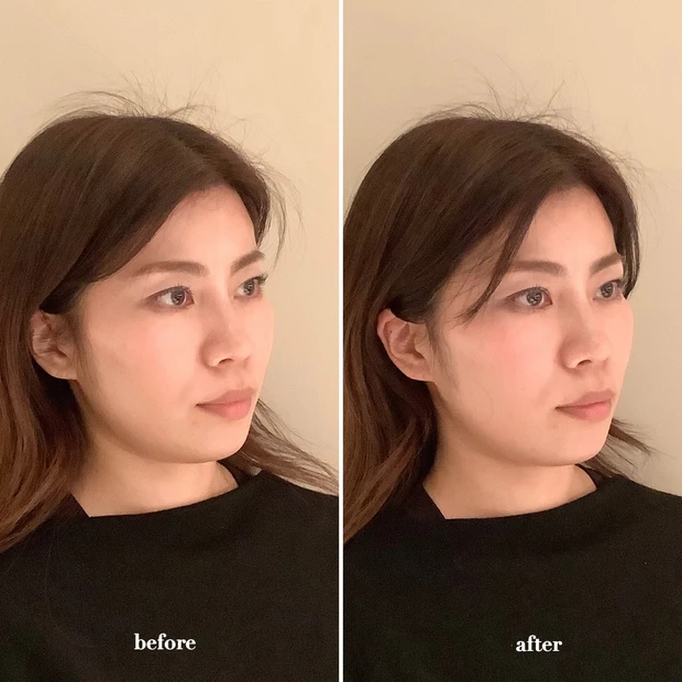 カドモリ 小顔 小顔矯正 骨格矯正 美容鍼 ハリネズミ エラ 頬骨 フェイスライン