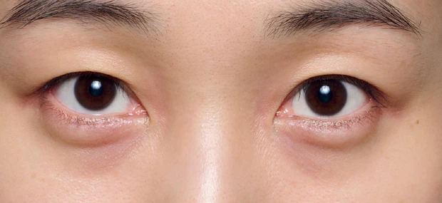 紫ぐま×たるみぐまタイプのくまカバー＆涙袋メイクのテクニック ビフォー