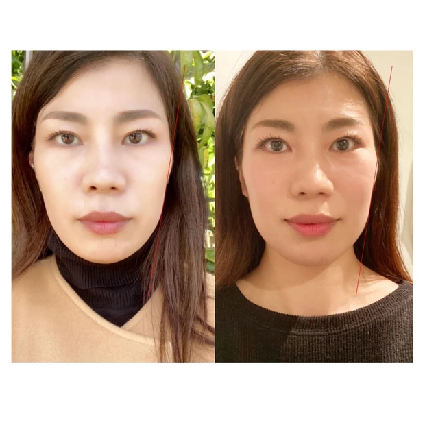 大掃除は始めてますか 私は美骨矯正で 頬骨 のお片付けしてきました マキアオンライン Maquia Online 大掃除は始めてますか 私は美骨矯正で 頬骨 のお片付けしてきました マキアオンライン Maquia Online