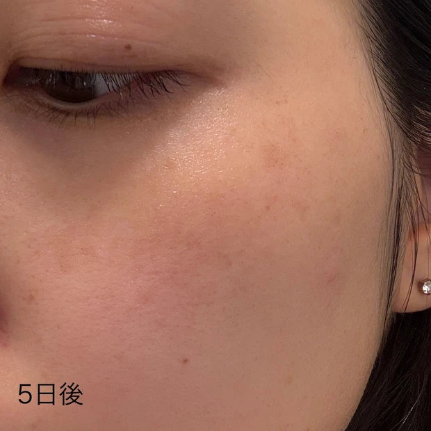 ルビーフラクショナル 5日後