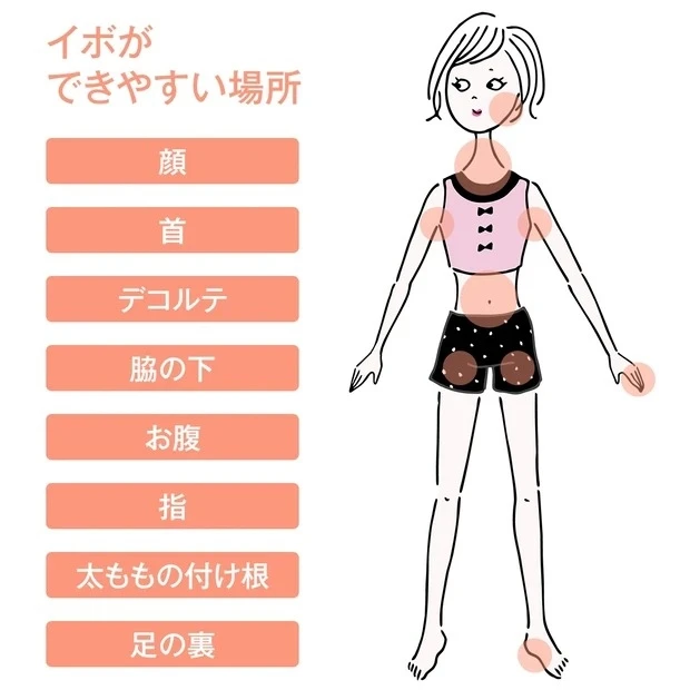 首まわりにポツポツできる「イボ」はどうすればいい？ 専門家が大人女子のお悩みに答えます！