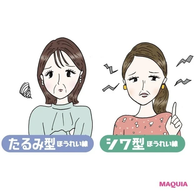 ほうれい線をどうにかしたい！ あなたのほうれい線、どっち？