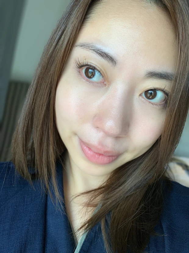 美容医療初心者におすすめの肌管理「ピコトーニング&ピコフラクショナル」リアルレポ_9