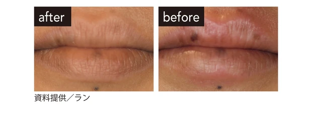 くすみには口唇ピコレーザー