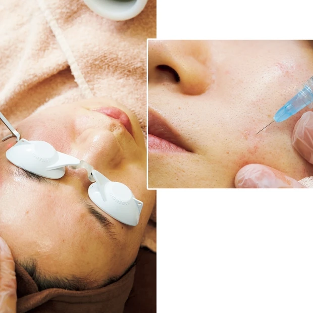 ニキビ跡、たるみ毛穴、毛穴ジミに！ セルフケアだけじゃ限界なときの駆け込…