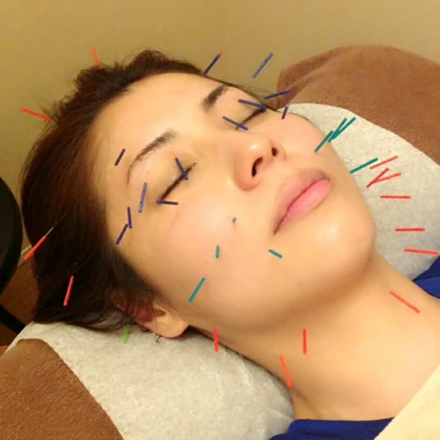 鍼灸美容で新境地@リンドウー治療院 赤坂一ツ木通り店