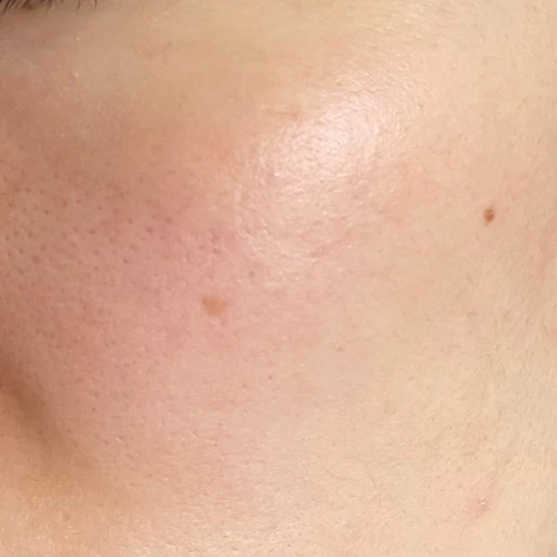 スポットシミケアを２種比較。できちゃったシミにも効くの？答えはYES!!_2_1