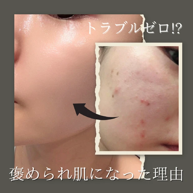 肌が綺麗になったスキンケアを紹介します🙌🏽 (本気で悩む方へ)