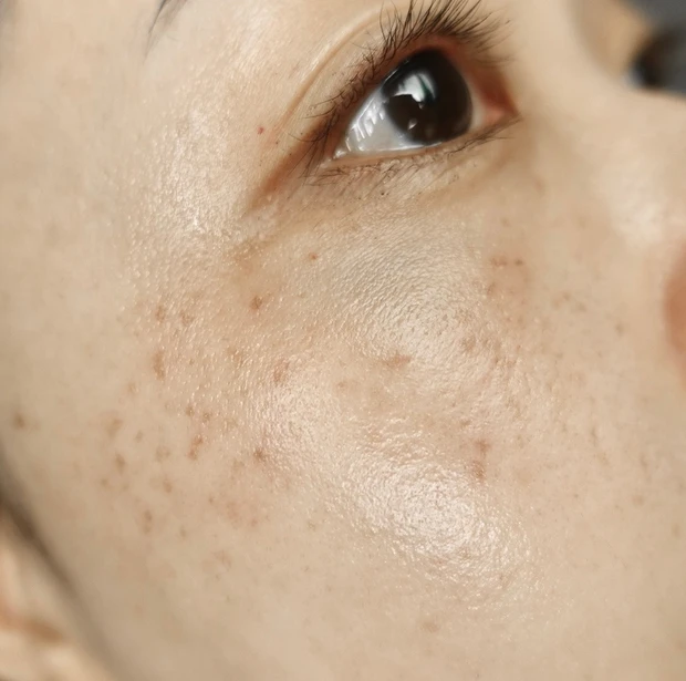 【ご当地美容】上海のヨセミテクリニックでM22(IPL治療)を受けてみた！6回コースでシミそばかすに効果あり！_4_2