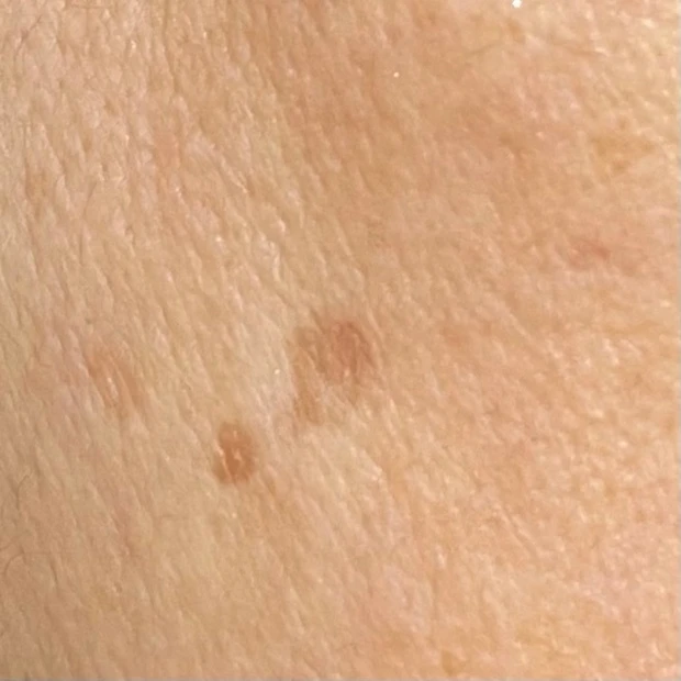 スポットシミケアを２種比較。できちゃったシミにも効くの？答えはYES!!_4_1