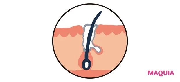 「つまり毛穴」を引き起こす5つの主な原因_5.白くてゆるい角栓がつまっている