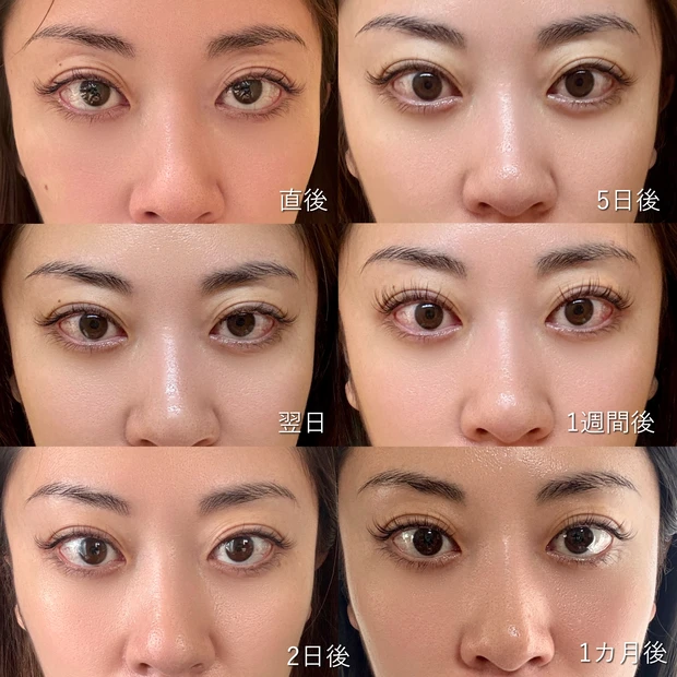 【体験レポ】やってよかった！初心者におすすめ！ナチュラルに仕上がる「糸リフト（スレッドリフト）」経過・クリニック紹介_7