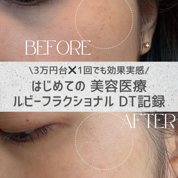 【3万円台✖️1回でも効果実感】はじめての美容医療。ルビーフラクショナルDT記録。