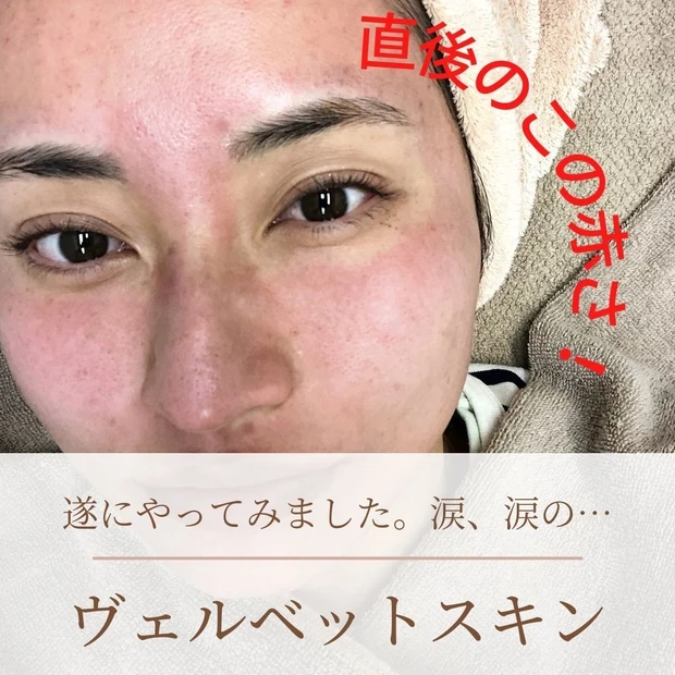 【2021年総まとめ】今年受けた美容医療!徹底解説!_3_2