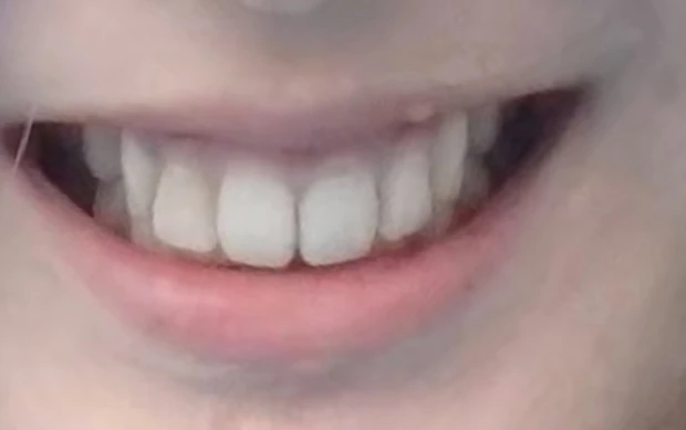 過蓋咬合