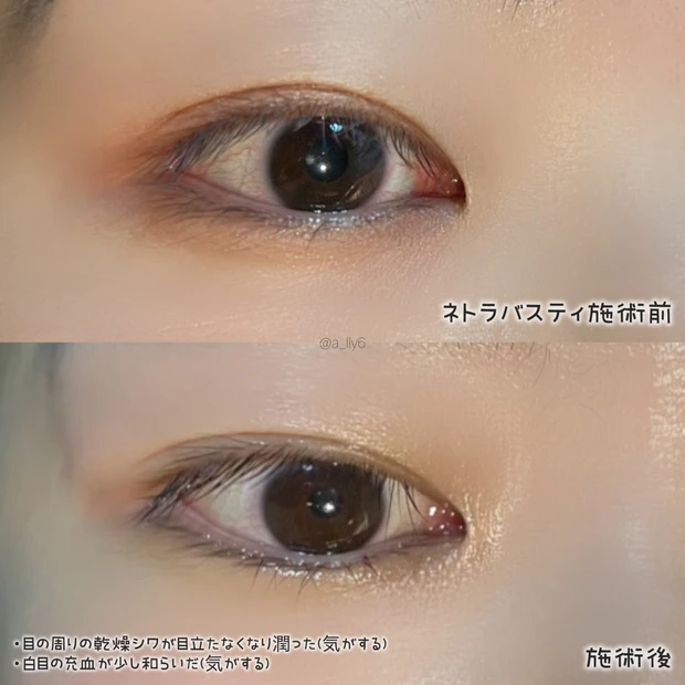 【30代以上必見👀】目に油を注ぐ!? インド伝承のネトラバスティ体験してきた📝´-_3