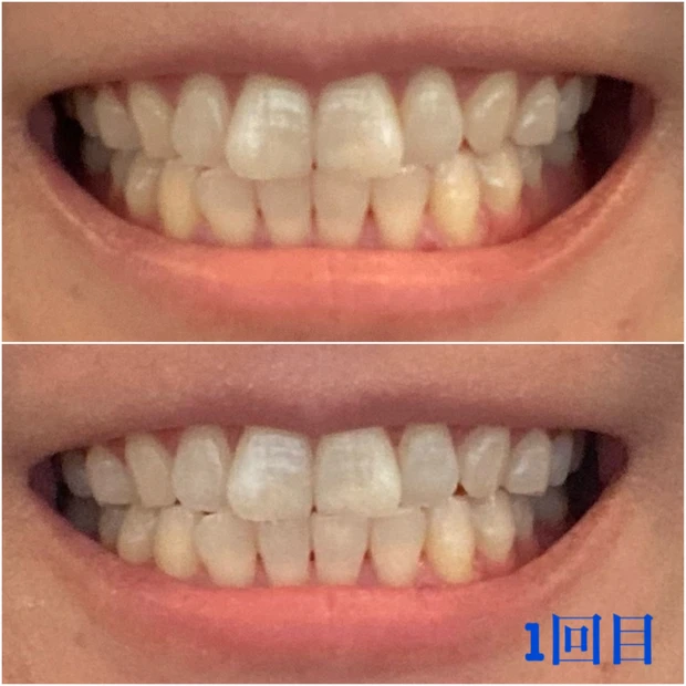 【１５年ぶりに家でお手軽セルフホワイトニング🦷✨】進化を実感😍Crest「3D Whitestrips」🪥_3_3