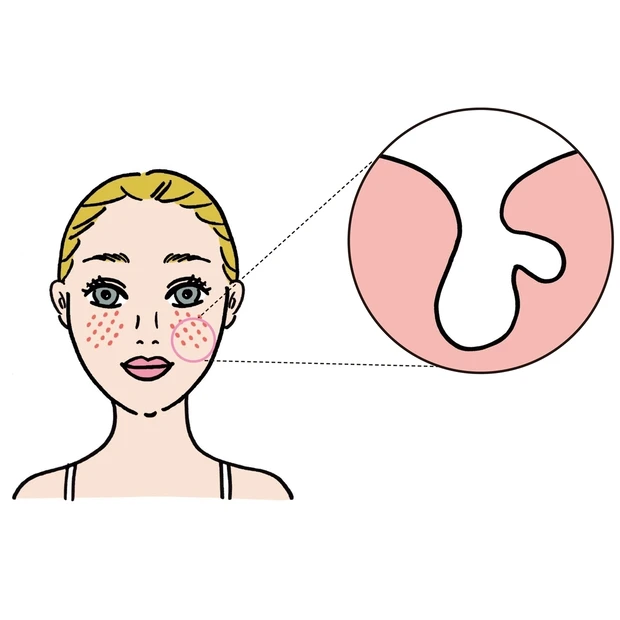 加齢で起こる「たるみ毛穴」注意報！ 幹細胞系、ビタミンAコスメで弾力アッ…