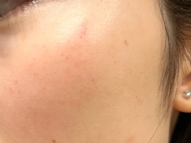 ルメッカ照射後