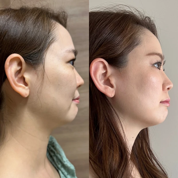 【ダウンタイムなしでたるみ軽減！】年末ご褒美美容医療「ハイドラジェントル×ボルニューマ」2週間後経過_7