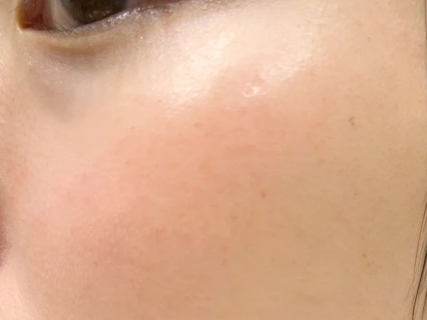 ルメッカ照射後