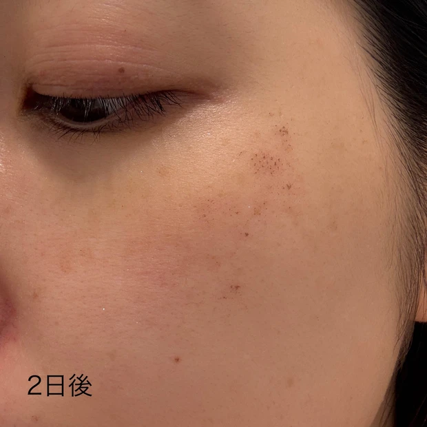 ルビーフラクショナル 2日後