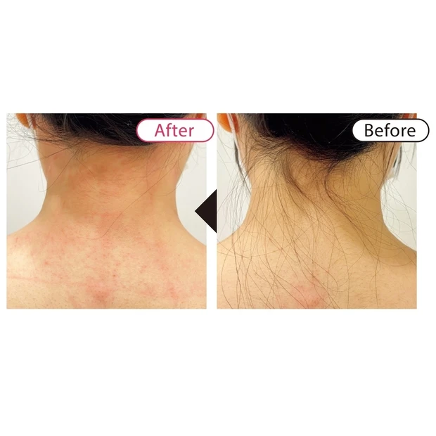 汗・体臭、ムダ毛の悩みを解消するには？ ドクターおすすめの「美容医療」を…