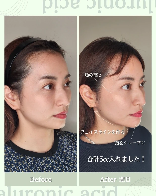 AYAMI_ヒアルロン酸注入_美容医療_真山綾美