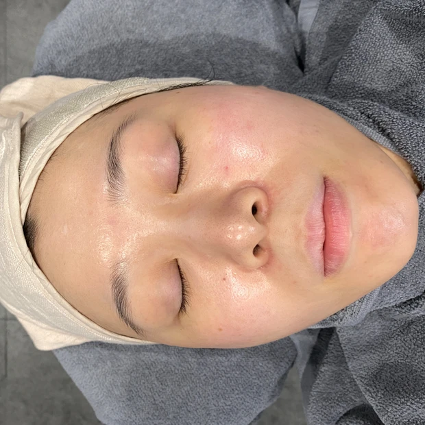 やまさや、ついに美容医療デビューしました♡︎【ハイドラフェイシャル体験レポート】_9_1