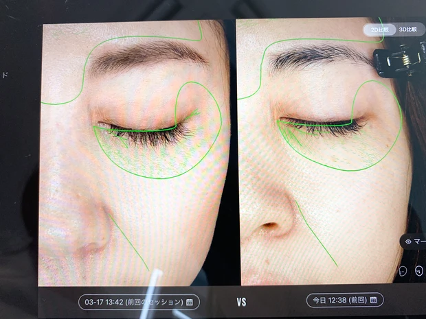 エンビロン初心者も！水素×ビタミンの力で“脱肌荒れ”を目指すフェイシャルエステ「アンジェラックススキンセンター渋谷」《秋の乾燥肌スキンケア》_5