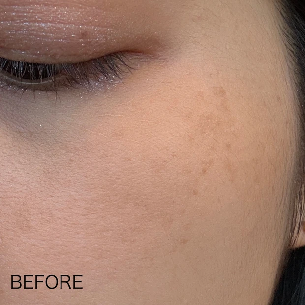 ルビーフラクショナル施術前