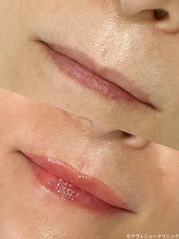 アヴェニュークリニック アートメイク リップ症例写真