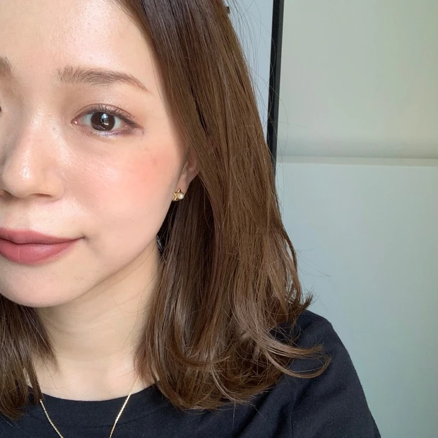 【ご当地美容】上海のヨセミテクリニックでM22(IPL治療)を受けてみた！6回コースでシミそばかすに効果あり！_10_1