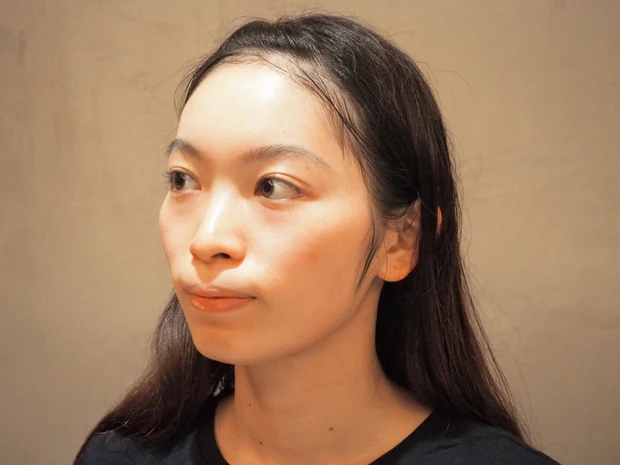 【話題の美容医療レポ】ダーマペンより効果あり？！水光注射を体験_2_2