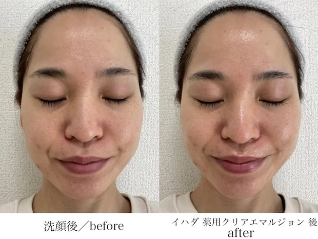 「イハダ 薬用クリアエマルジョン」ビフォーアフター