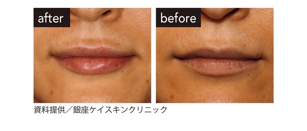 萎み（しぼみ）対策はヒアルロン酸注入