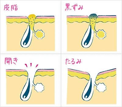 皮脂・黒ずみ・開き ・たるみの4タイプ