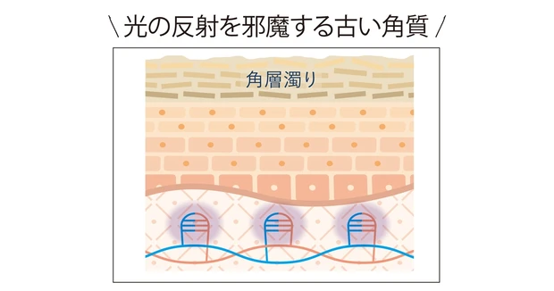 光の反射を邪魔する古い角質