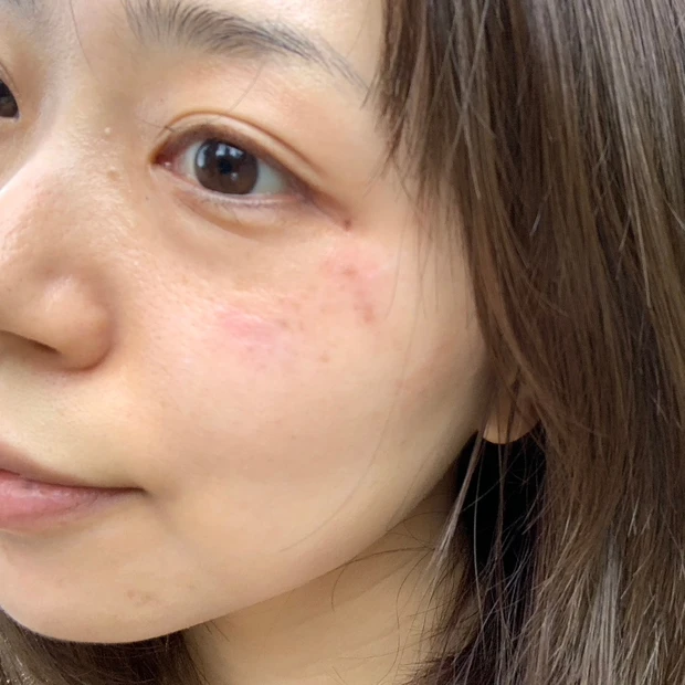 【ご当地美容】上海のヨセミテクリニックでM22(IPL治療)を受けてみた！6回コースでシミそばかすに効果あり！_2_2