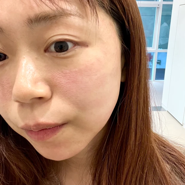 【韓国美容医療①】プムグローバル江南でポテンツァ＆ボトックス体験レポ！_12_1