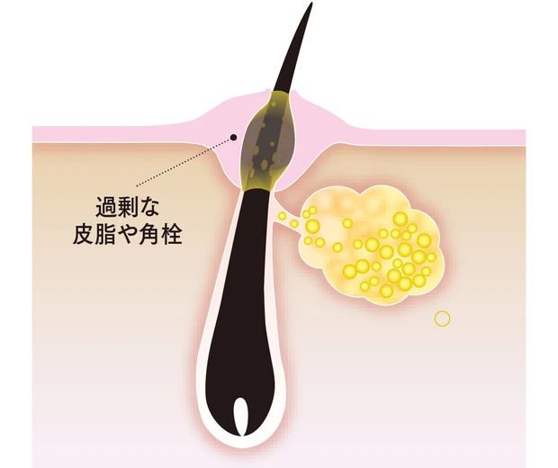【トラブル肌のメカニズム】シミ、シワ、たるみ、乾燥、毛穴etc.におすすめのコスメ_1_43