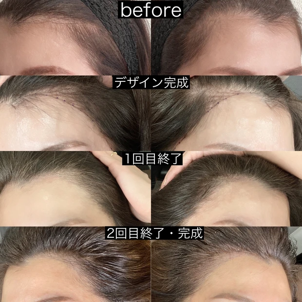 施術動画あり!ヘアラインアートメイクって知ってる?生え際のアートメイクとっても気に入ったのでレビューします!
_6