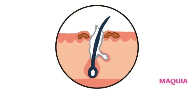 「つまり毛穴」を引き起こす5つの主な原因_3.色素沈着