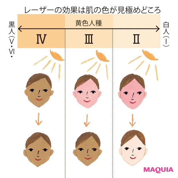 できてしまったシミを消す、最新メソッド 【レーザー、光治療】予算目安も掲…