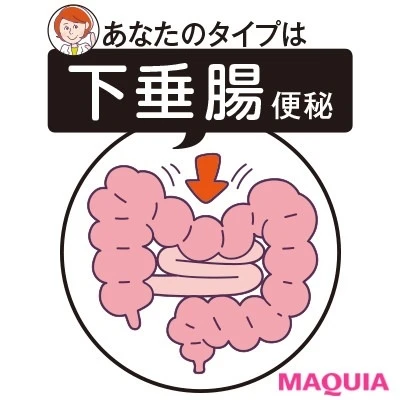 【便秘解消におすすめ】下垂腸便秘タイプさん_筋力不足や糖質過多で腸が下垂