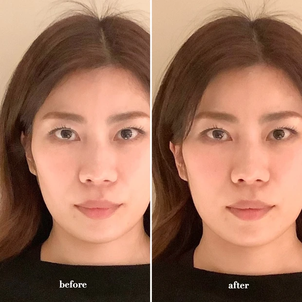 カドモリ 小顔 小顔矯正 骨格矯正 美容鍼 ハリネズミ エラ 頬骨 フェイスライン