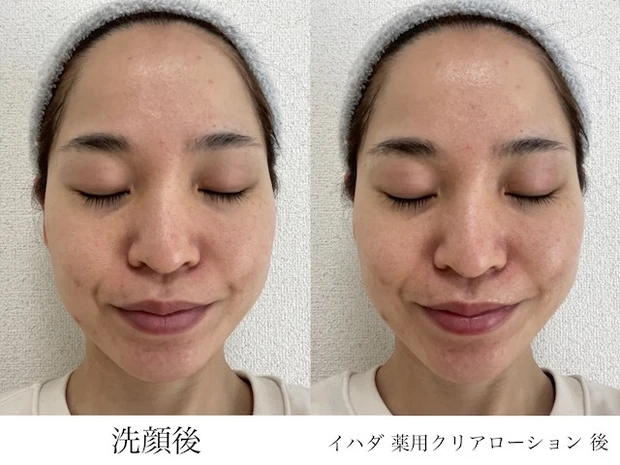 「イハダ 薬用クリアローション」ビフォーアフター