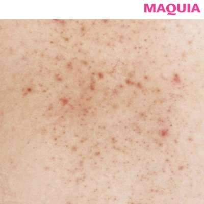 ニキビ ニキビ跡のお悩みに 化粧水 洗顔などおすすめスキンケアを専門家が解説 マキアオンライン Maquia Online