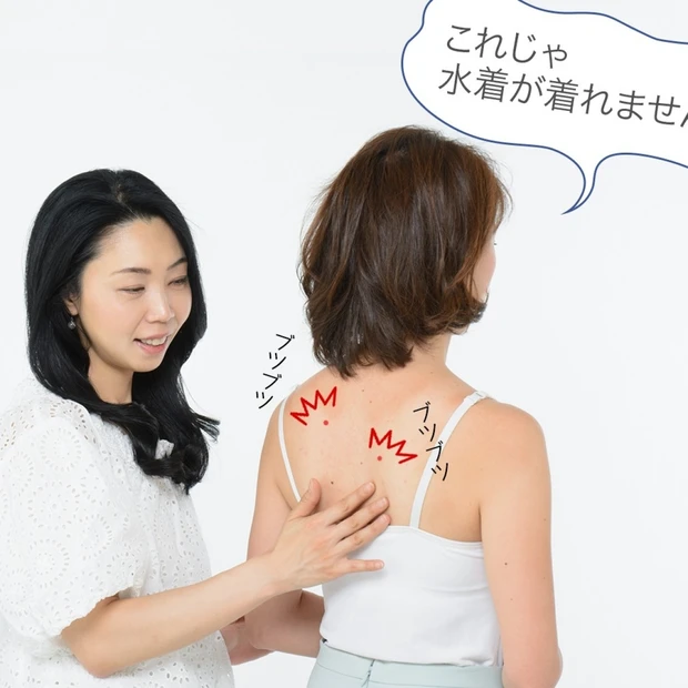 「イマドキ女子のお悩みに答えます！」 〜背中ニキビができて困ってます～