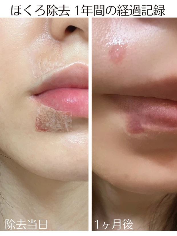 ほくろ除去 経過レポート ビフォーアフター 美容医療 体験談